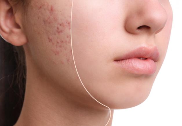 Elazığ Akne Tedavisi