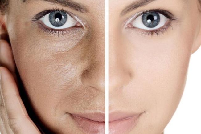 Elazığ Gözenek Tedavisi