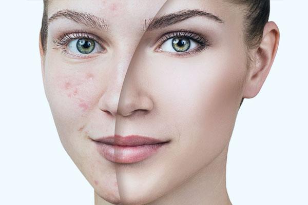 Elazığ Leke Tedavisi